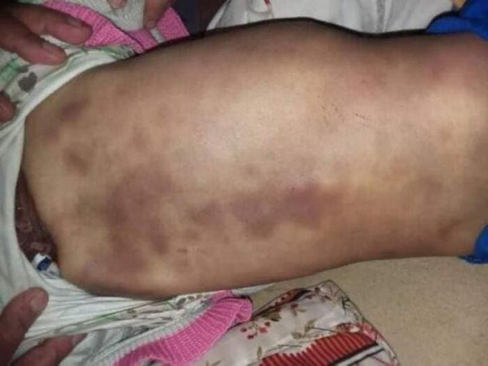 جريمة ارتكبتها "زوجة الأب".. تعذيب وضرب طفلة "حتى الموت" في صنعاء "صورة"