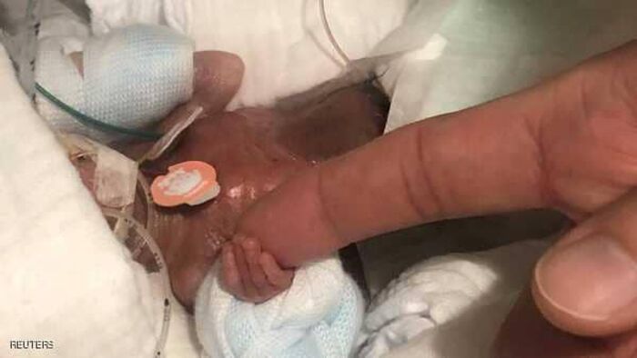 بالصور | لن تصدق ذلك, شاهد أصغر رضيع في العالم يحقق "المعجزة" ويغادر المستشفى