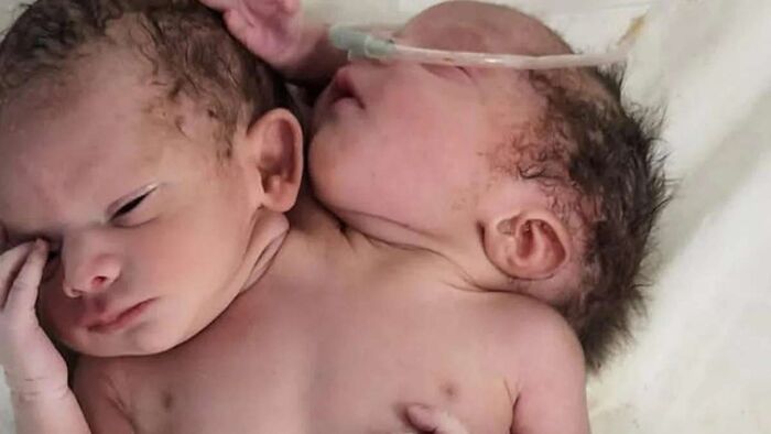 ولادة طفل برأسين وثلاثة أذرع "صور"