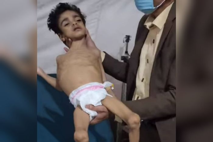 طفل يواجه الموت جوعًا في حجة