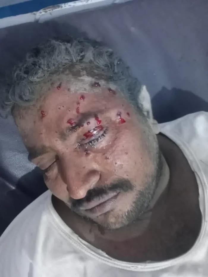 إصابة مدني بانفجار لغم من مخلفات الحوثيين في حيس