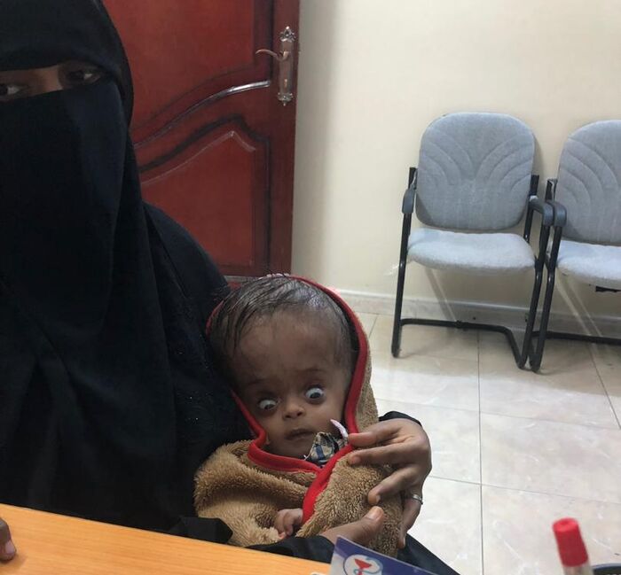 د. السباعي: إستجابة عاجلة من "هلال الإمارات" لعلاج طفل يعاني من إستسقاء بالدماغ "صور"