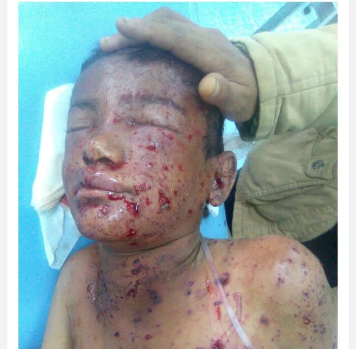 العميد طارق صالح يتكفل بعلاج طفل من أهالي مقبنة تعز أصيب بانفجار لغم حوثي "صورة"